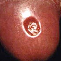 Example of a primary syphilis sore