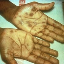 Examples of a secondary palmar rash (above) and a generalized body rash (below)